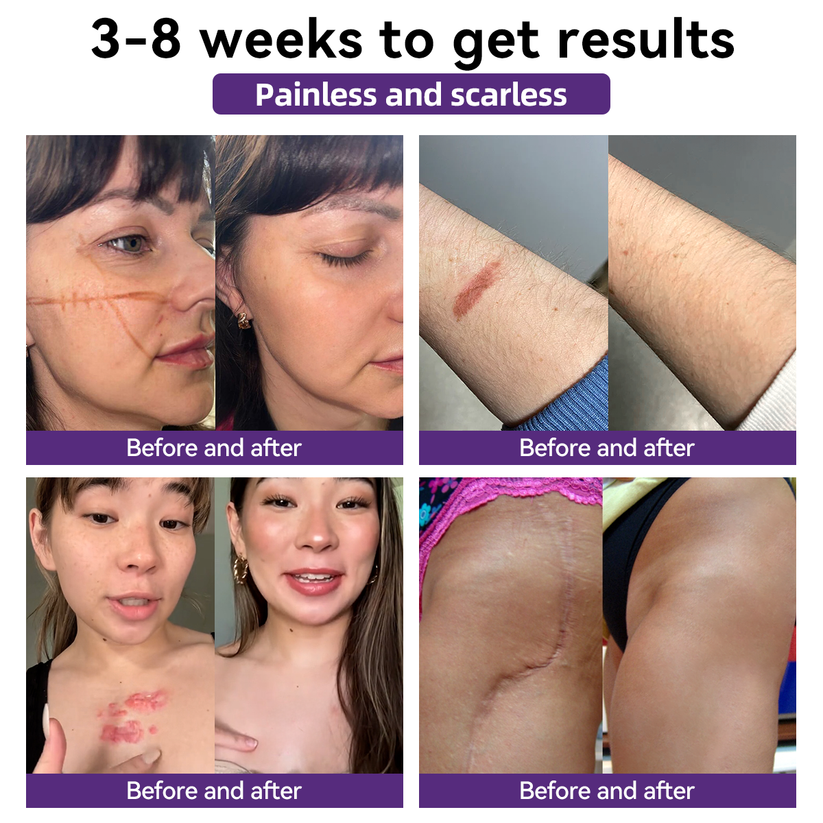 [Limited time discount sale🔥] Advanced Scar Gel