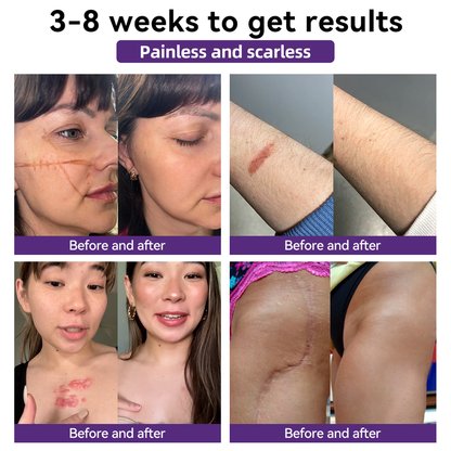 [Limited time discount sale🔥] Advanced Scar Gel