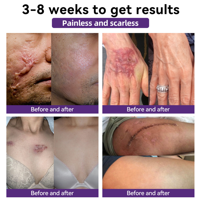 [Limited time discount sale🔥] Advanced Scar Gel