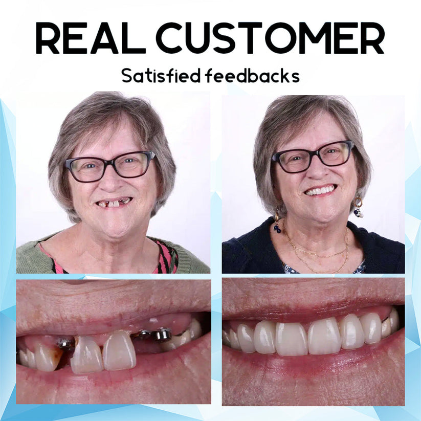 𝐒𝐢𝐥𝐢𝐜𝐨𝐧𝐞 𝐑𝐞𝐥𝐢𝐧𝐞 𝐃𝐞𝐧𝐭𝐮𝐫𝐞 𝐒𝐞𝐭 (⏰𝐋𝐢𝐦𝐢𝐭𝐞𝐝 𝐭𝐢𝐦𝐞 𝐝𝐢𝐬𝐜𝐨𝐮𝐧𝐭 𝐋𝐚𝐬𝐭 𝟑𝟎 𝐦𝐢𝐧𝐮𝐭𝐞𝐬⏰)