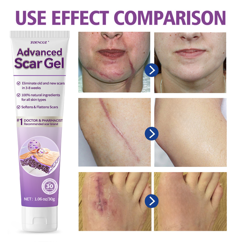 [Limited time discount sale🔥] Advanced Scar Gel