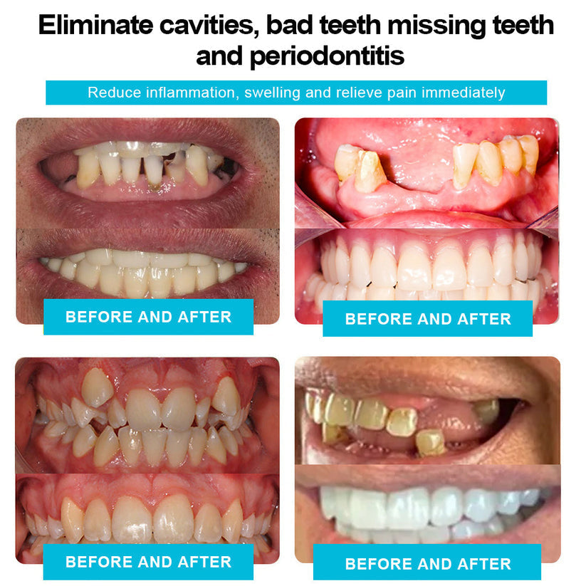 𝐒𝐢𝐥𝐢𝐜𝐨𝐧𝐞 𝐑𝐞𝐥𝐢𝐧𝐞 𝐃𝐞𝐧𝐭𝐮𝐫𝐞 𝐒𝐞𝐭 (⏰𝐋𝐢𝐦𝐢𝐭𝐞𝐝 𝐭𝐢𝐦𝐞 𝐝𝐢𝐬𝐜𝐨𝐮𝐧𝐭 𝐋𝐚𝐬𝐭 𝟑𝟎 𝐦𝐢𝐧𝐮𝐭𝐞𝐬⏰)