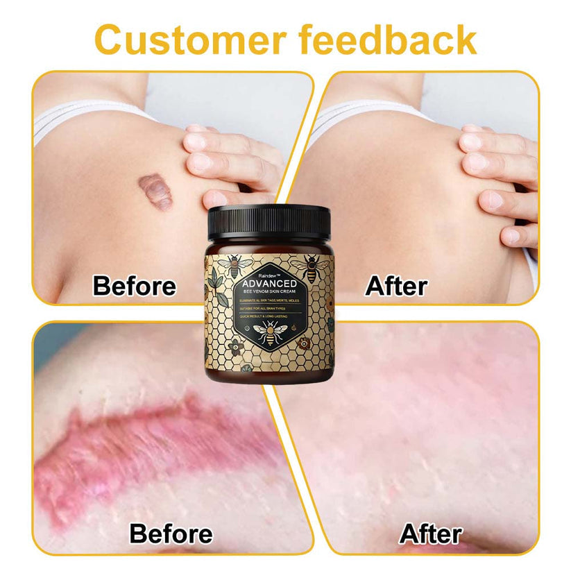 Advanced Bee Venom Skin Cream👨‍⚕️🌿(🔥𝑳𝒂𝒔𝒕 𝒅𝒂𝒚 𝒑𝒓𝒐𝒎𝒐𝒕𝒊𝒐𝒏 8𝟎% 𝒐𝒇𝒇)