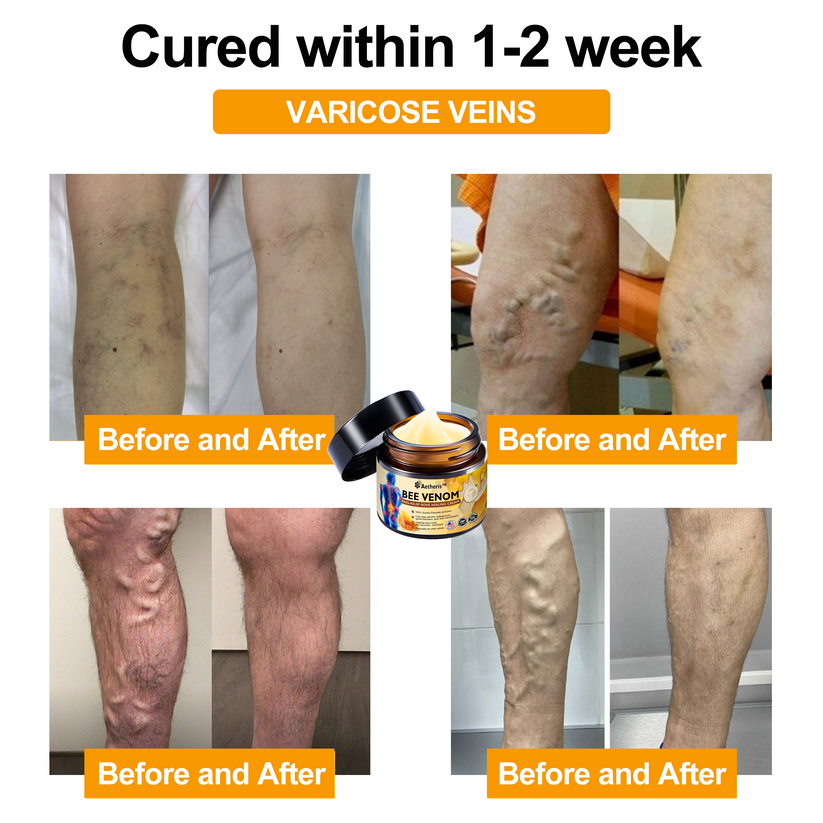 Official Store: Aetheris™ Bee Venom Instant Ultra Strength Pain Relief Therapy Cream-(Provides pain eliminate for Arthritis, Muscle, Back Pain, Knees, Back, Shoulders, Hips, Wrists, Hands)