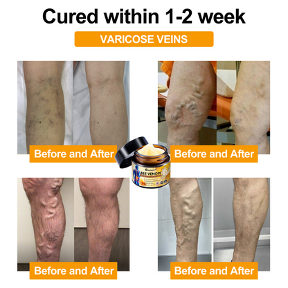 Official Store: Aetheris™ Bee Venom Instant Ultra Strength Pain Relief Therapy Cream-(Provides pain eliminate for Arthritis, Muscle, Back Pain, Knees, Back, Shoulders, Hips, Wrists, Hands)