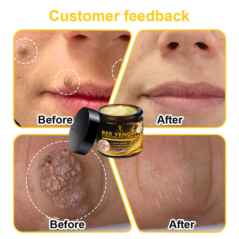 Bee Venom Skin Cream🔥𝑳𝒂𝒔𝒕 𝒅𝒂𝒚 𝒑𝒓𝒐𝒎𝒐𝒕𝒊𝒐𝒏 7𝟎% 𝒐𝒇𝒇