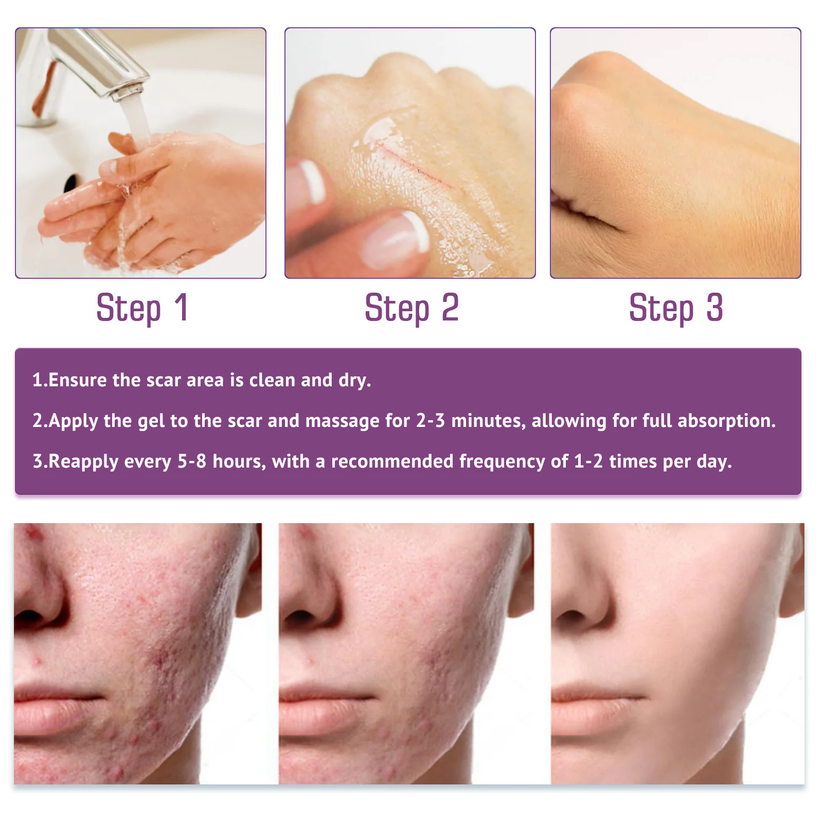 [Limited time discount sale🔥] Advanced Scar Gel