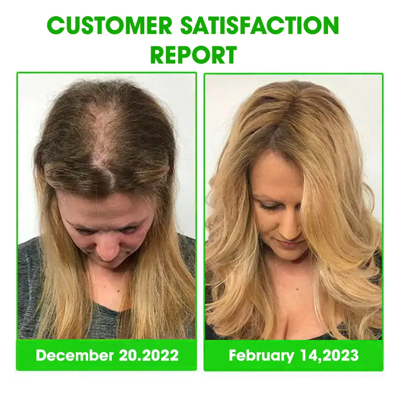 Scalp Treatment HairGrᴏᴡth Serum (Hurry, 80% OFF - Only 30 minutes left 🫧)