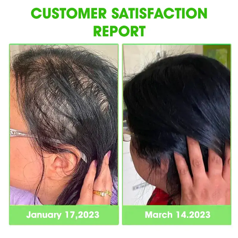 Scalp Treatment HairGrᴏᴡth Serum (Hurry, 80% OFF - Only 30 minutes left 🫧)