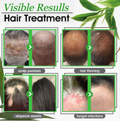 Scalp Treatment HairGrᴏᴡth Serum (Hurry, 80% OFF - Only 30 minutes left 🫧)